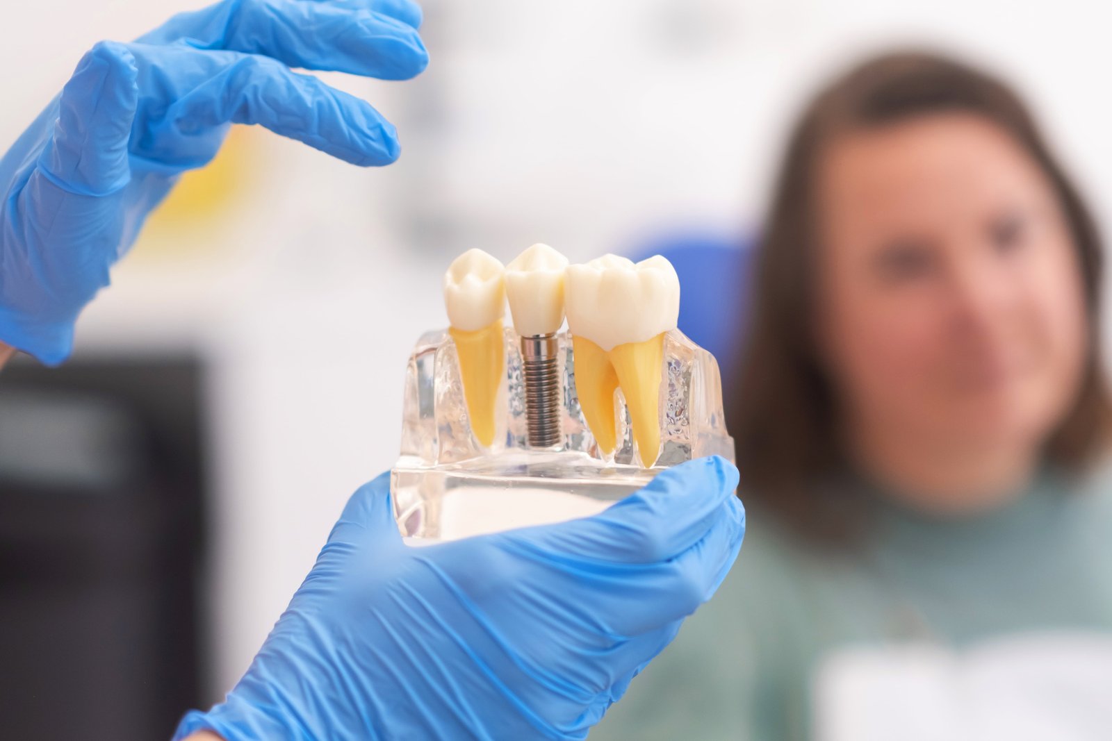 All-on-4 Implants